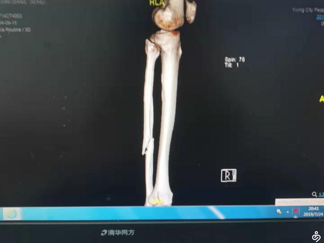 胡金秋左侧腓骨骨折的相关图片